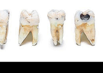 Как выглядит кариес: фото зубов, пришеечный, глубокий, кариес у детей и взрослых 